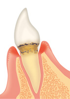 歯周病の症状