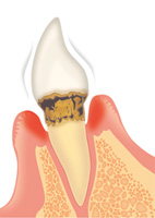 歯周病の症状