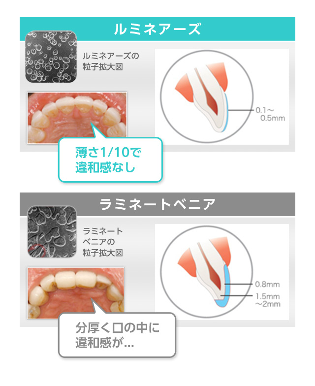 ルミネアーズ、薄さ1/10で違和感なし。ラミネートベニア、分厚く口の中に違和感が...