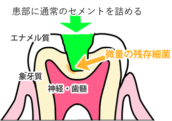 患部に通常のセメントを詰める