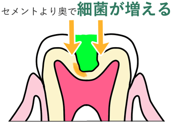 セメントより奥で細菌が増える