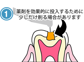 薬剤を効果的に投入するために少しだけ削る場合があります