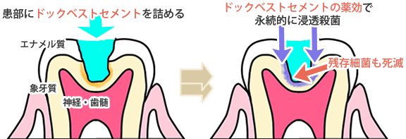 ドックベストセメントの治療図解