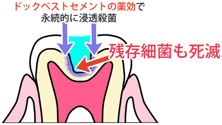 ドックベストセメントの薬効で永続的に浸透殺菌