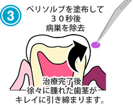 ペリソルブを塗布して30秒後病巣を除去治療完了後徐々に腫れた歯茎がキレイに引き締まります。