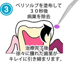 ペリソルブを塗布して３０秒後病巣を除去治療完了後徐々に腫れた歯茎がキレイに引き締まります。